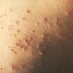 What is Swimmers Itch and How to Treat It.